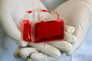 درمان بیماری سپسیس با سلول‌های بنیادی خون بندناف 