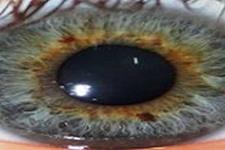 رنگ چشم، شاخصی برای خطر ابتلا به بیماری های پوستی 