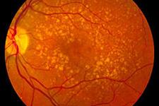 شناسایی هفت ژن جدید مرتبط با نابینایی در سالمندان