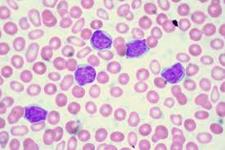 موفقیت داروی جدید سرطان خون در مطالعات بالینی