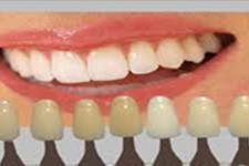 سمینار سلول های بنیادی به جای ایمپلنت دندانی برگزار می شود
