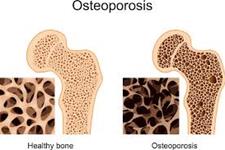 سلول درمانی با اثرات پوکی استخوان ناشی از استئوپورز مقابله می کند