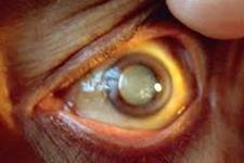 تزریق سلول های بنیادی ممکن است خیلی زود بینایی از دست رفته به دلیل دژنراسیون ماکولای وابسته به سن را احیا کند