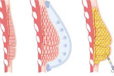 جراحی های بازسازی سینه با استفاده از تکنیک سلول های بنیادی افزایش یافته است
