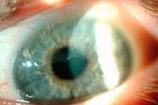 استفاده از بافت چشمی اهدایی و امیدواری در جراحی سلول های بنیادی