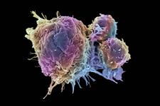 رشد سرطان در بدن می تواند از یک سلول منشا بگیرد