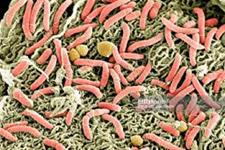 پیوند میکروبیوم مدفوع به احیای باکتری های سودمند در بیماران سرطانی کمک می کند