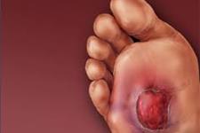 تمرکز مطالعات بالینی سلول های بنیادی مشتق از چربی روی زخم پای بهبود نیابنده