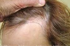 نازک شدن مو با از دست رفتن سلول های بنیادی