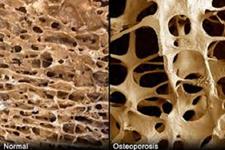 آیا زنجیره های قندی می توانند کلید رشد استخوان در استئوپورز باشند؟