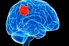 کشف دارویی جدید برای متوقف کردن پراکنش سرطان مغز 