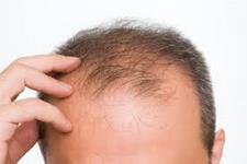کسب اطلاعاتی در مورد یک بیماری پوستی نادر و وراثتی و کمک به درمان اختلالات مو