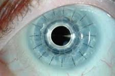 سلول های بنیادی ممکن است به احیای بینایی بعد از سوختگی های شیمیایی شدید کمک کنند