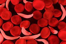 مطالعه ای پیشگامانه که می تواند منجر به درمانی جدید برای بیماری کم خونی داسی شکل شود