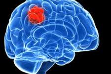 افزایش بقای بیماران مبتلا به سرطان مغزی با استفاده از سلول های بنیادی