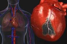حمله قلبی: تولید جایگزین های عضلانی به لطف سلول های بنیادی