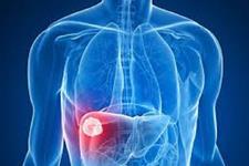 یک داروی ضد رد پیوند شایع می تواند برای درمان برخی از سرطان های کبدی استفاده شود