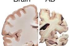 بررسی الگوهای تخریب مغز در بیماری آلزایمر