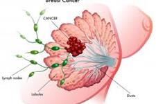 عامل سرطان سینه HER2، در سه درصد سرطان های ریوی نیز وجود دارد