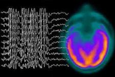 دستگاه الکترونیکی ایمپلنت شده به مغز می تواند تشنج را متوقف کند