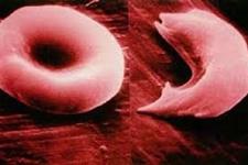 سلول های بنیادی اهدایی ناسازگار می توانند بیماران بالغ مبتلا به کم خونی داسی شکل را درمان کند