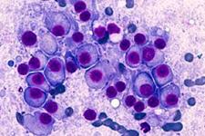 توصیه های صادر شده در زمینه پیوند سلول های بنیادی خون ساز در مولتیپل میلوما