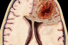 هر ناحیه از تومورهای گلیوبلاستومایی با زیرنوع های مجزایی از سلول های بنیادی گلیومایی مرتبط است