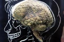 موتاسیون ها توضیح می دهند که چرا برخی از افراد به عفونت های مغزی ویروسی آسیب پذیرتر هستند