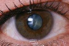 سلول های بنیادی ‌و بازسازی عدسی چشم در کاتاراکت