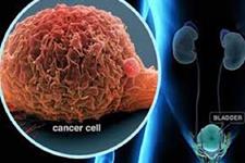 شناسایی منشا سلولی سرطان تهاجمی مثانه