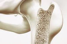 گامی جدید در تحقیقات برای درمان بیماری های استخوان
