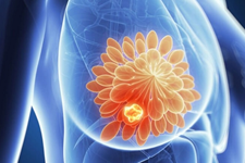 روشی جدید برای از بین بردن سلول‌های بنیادی سرطان سینه 