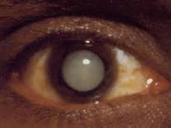 شناسایی مراحل تکوینی تومورهای چشم در کودکان