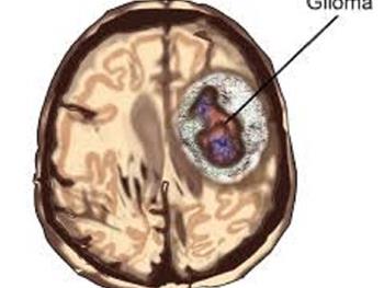 شناسایی موتاسیون ژنی مرتبط با شکل تهاجمی تومورهای مغزی 