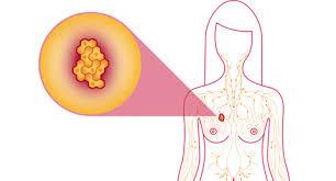 علت بی اثر بودن رتینوئیک اسید در درمان سرطان سینه