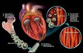 سلول های بنیادی پیوند شده از مغز استخوان به قلب می توانند عملکرد قلبی را بهبود ببخشند