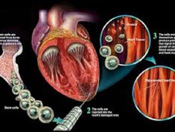 پژوهش های بیشتر برای سلول درمانی نوزادان مبتلا به سندرم هایپوپلازی قلب چپ