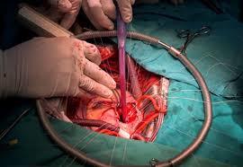 استخراج سلول های بنیادی از سیاهرگ های برجای مانده از جراحی قلب