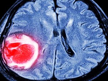 سلول های ایمنی اصلاح شده، رویکرد درمانی موثر در حذف تومور مغزی 