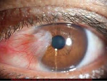 ایجاد یک برش در شبکیه می تواند به ترمیم عصب بینایی کمک کند