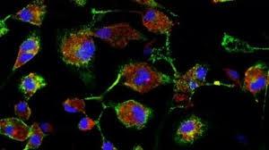 شناسایی سلول های ایمنی مداخله‌گر در ام اس فعال مزمن
