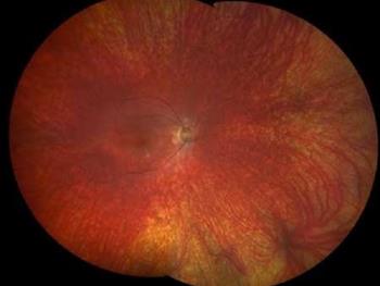 استفاده از سلول های بیماران برای تست ژن درمانی و درمان یک بیماری چشمی نادر